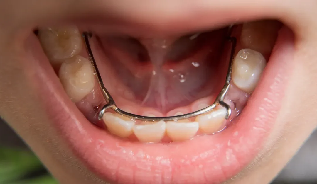 Dental Spacers for Kids: What Are They and When Are They Needed?