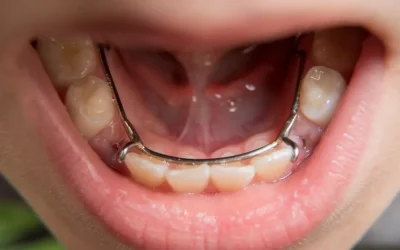Dental Spacers for Kids: What Are They and When Are They Needed?